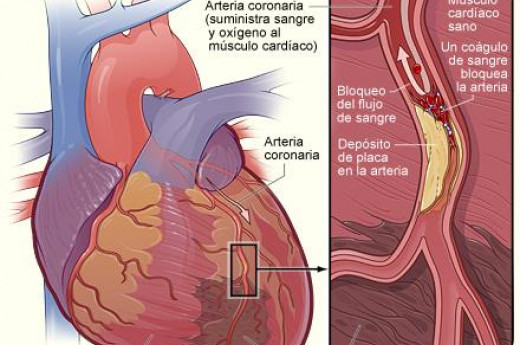Myocardia infarction 