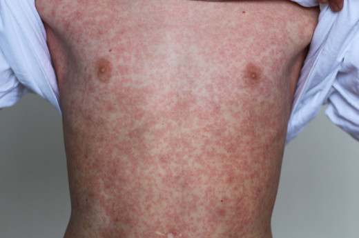 A person's chest with measles rash
